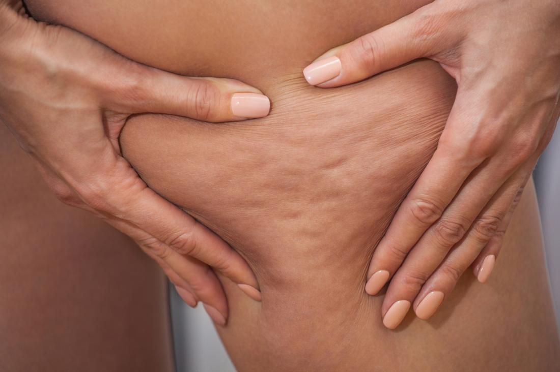 Anti-cellulite massage at home